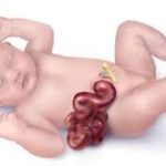 Understanding Gastroshiza: A Brief, Informative Overview