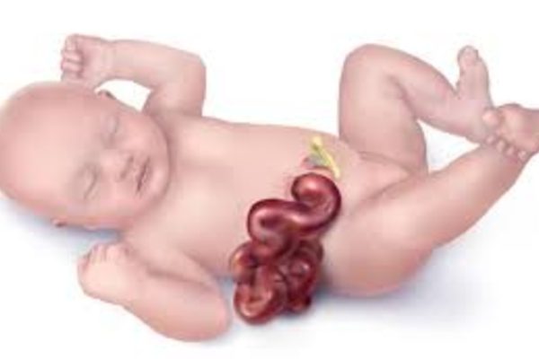 Understanding Gastroshiza: A Brief, Informative Overview