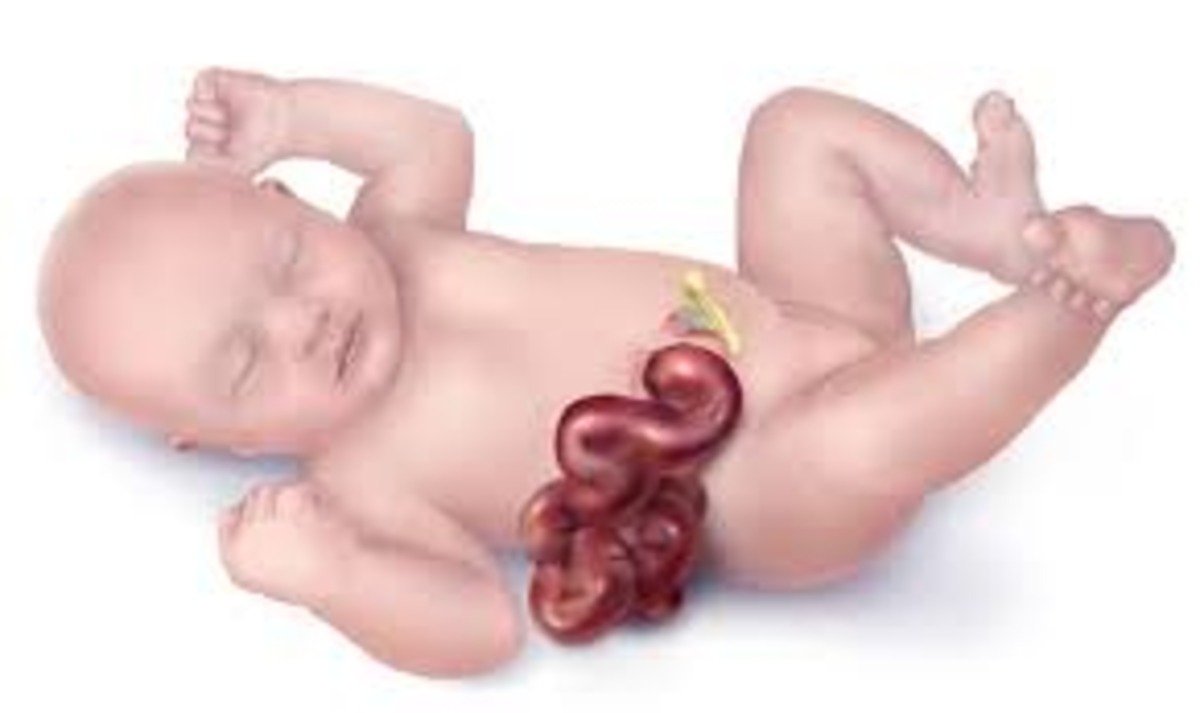 Understanding Gastroshiza: A Brief, Informative Overview